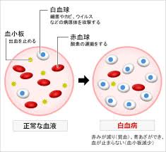 白血病を患った有名人は 白血病の初期症状 原因 余命をわかりやすくまとめました 癌は早期発見が大事なんだね